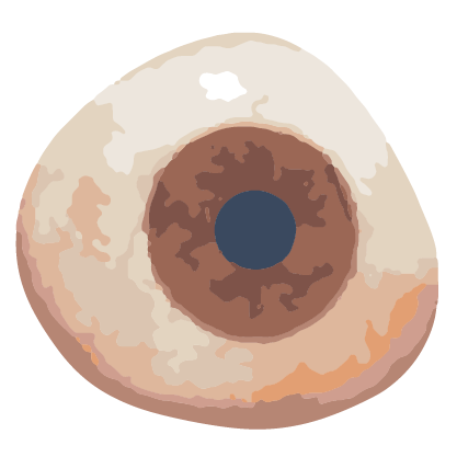 prótesis de ojo Cerprótesis