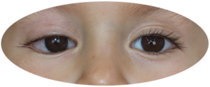 testimonio Prótesis oculares
