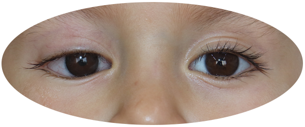 testimonio Prótesis oculares