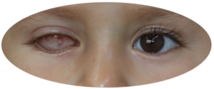 testimonio Prótesis oculares