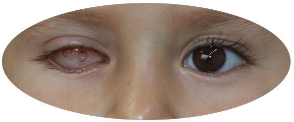 testimonio Prótesis oculares