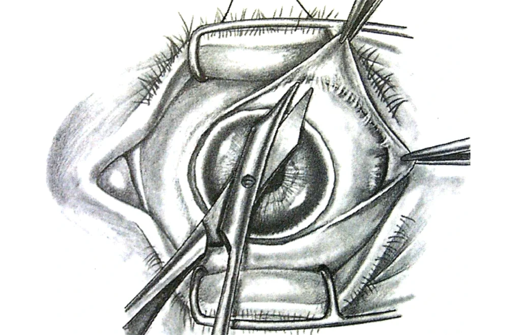 Enucleación 1