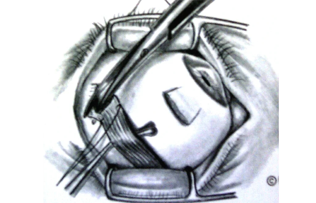 Enucleación 3