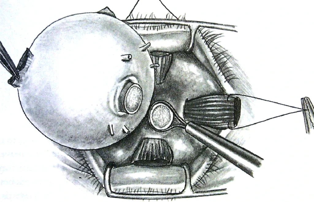 Enucleación 14
