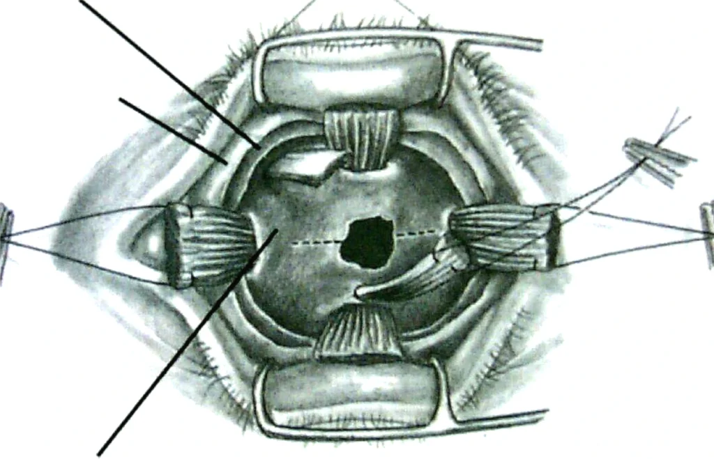 Enucleación 5