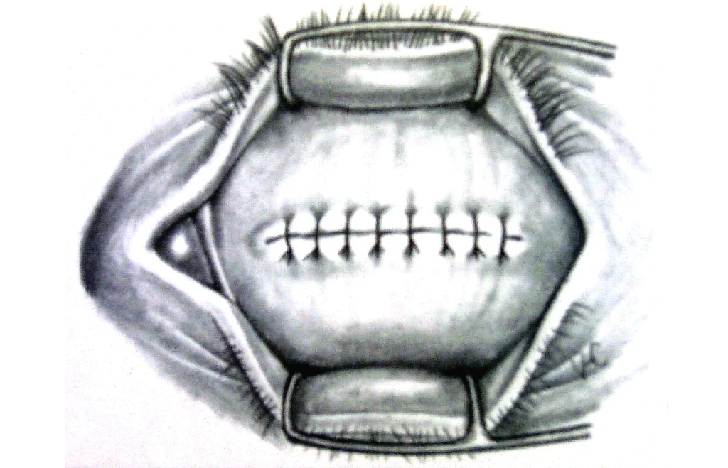 Enucleación 7