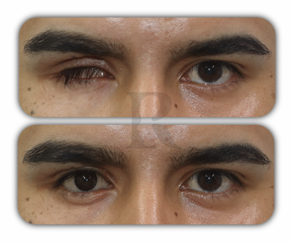 Prótesis Ocular antes y después