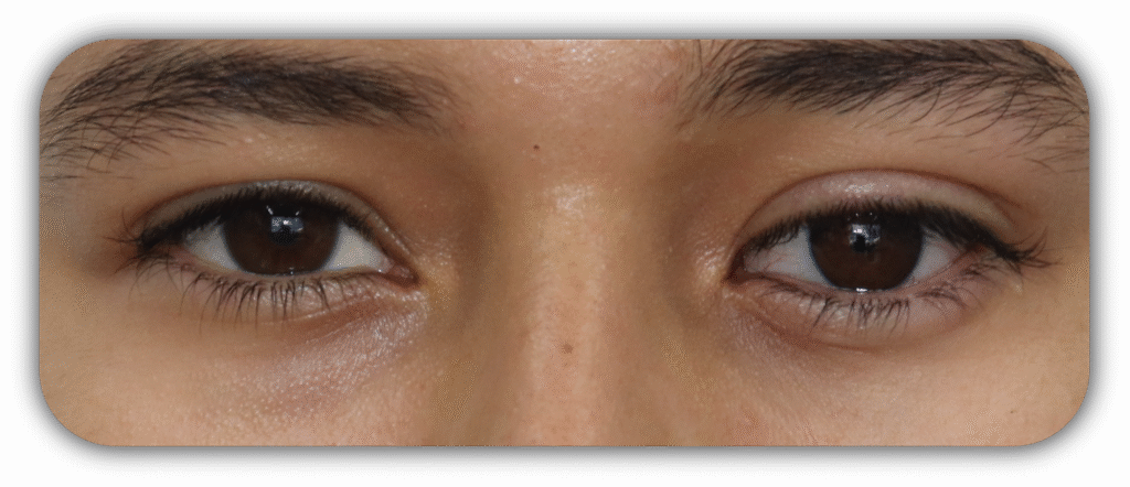 Prótesis testimonio 006 Prótesis testimonio 006