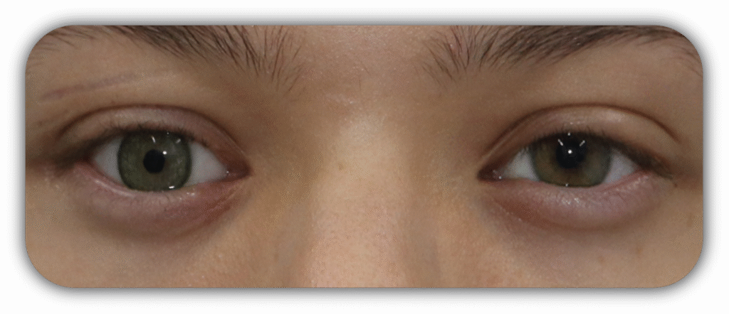 testimonios proteos oculares 001 testimonios proteos oculares 001